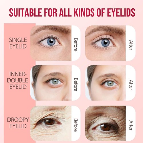 Invisible eyelid lift - eyelid,